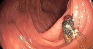 Caso raríssimo: médicos americanos descobriram uma mosca viva e intacta dentro do intestino de um homem Caso raríssimo: médicos americanos descobriram uma mosca viva e intacta dentro do intestino de um homem