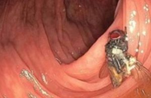 Caso raríssimo: médicos americanos descobriram uma mosca viva e intacta dentro do intestino de um homem Caso raríssimo: médicos americanos descobriram uma mosca viva e intacta dentro do intestino de um homem