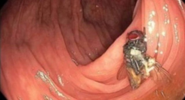 Caso raríssimo: médicos americanos descobriram uma mosca viva e intacta dentro do intestino de um homem